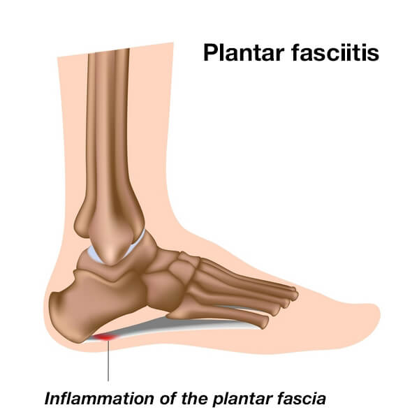 Foot and Heel Pain 2