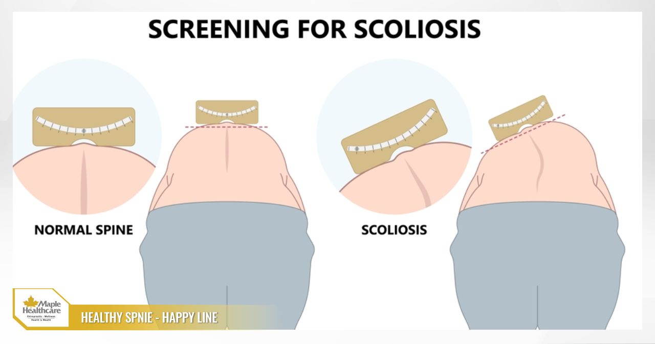 Adam's Forward Bend Test