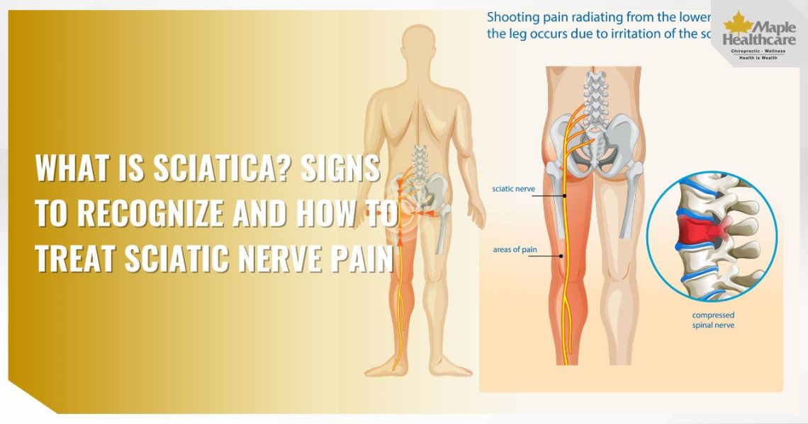 What Is Sciatica