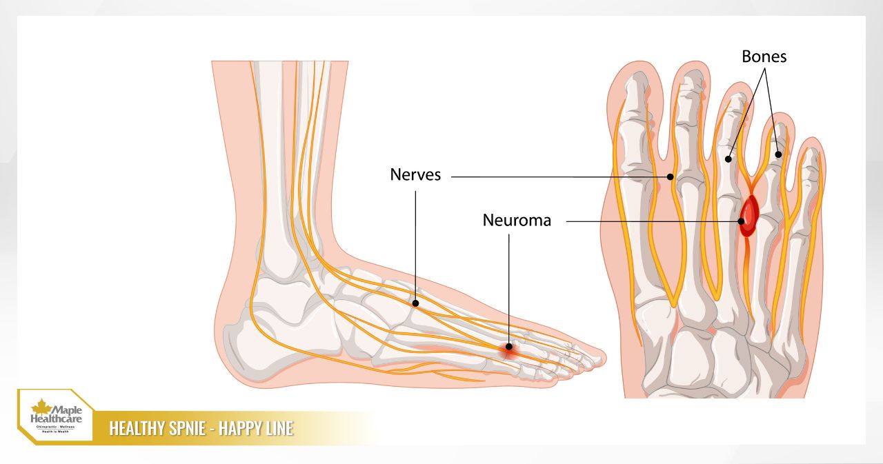 Morton's neuroma