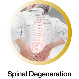 Spinal-degeneration-mobile